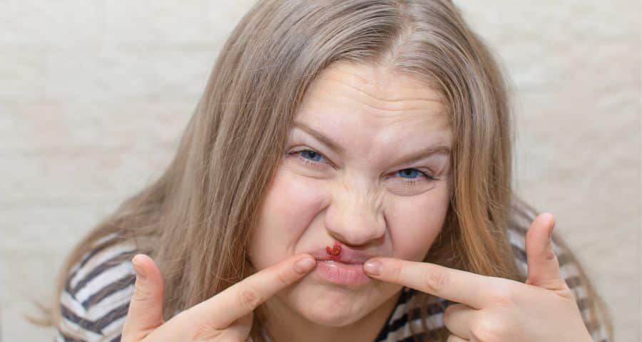 Are You Married to Someone with Cold Sores?