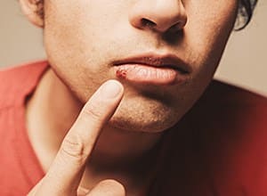 What's the Best Over the Counter Cold Sore Medicine?