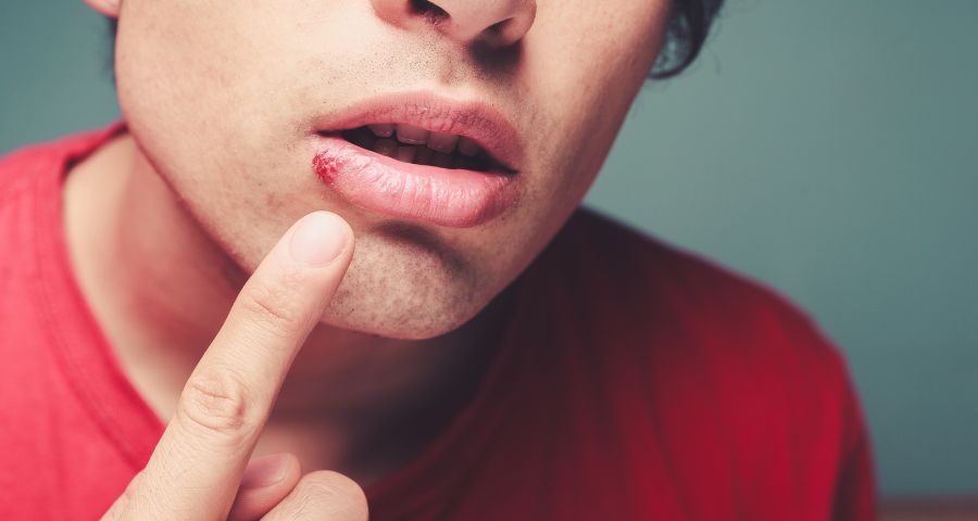 Cold Sores Vs Sun Blisters: What Is The Difference?