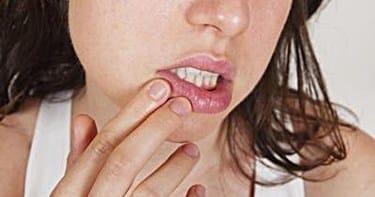 The Safe Treatment of Cold Sores and Mouth Ulcers in Early Pregnancy