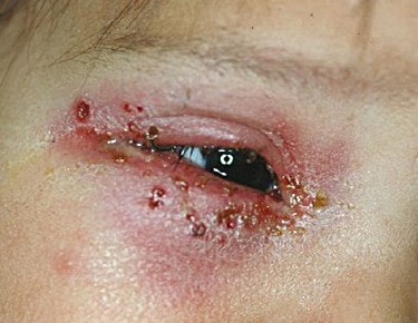 How to treat Cold Sores of the Eyes