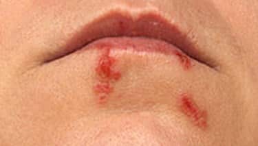 How are Cold Sores Transmitted?