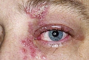 How Do Doctors Treat Cold Sores Near the Eyes [Ocular Herpes]?