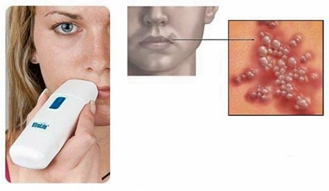 Cold Sore Treatment Comparison: Is Abreva or Orajel the Best?