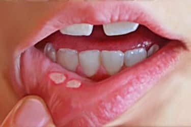 Treating Mouth Ulcers in early pregnancy