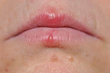 Finding Cold Sores below the Lower Lip Line