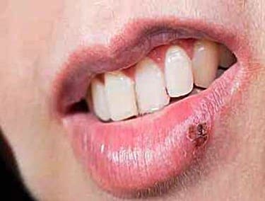 Do Cold Sores Leave Scars if You Disturb Them?